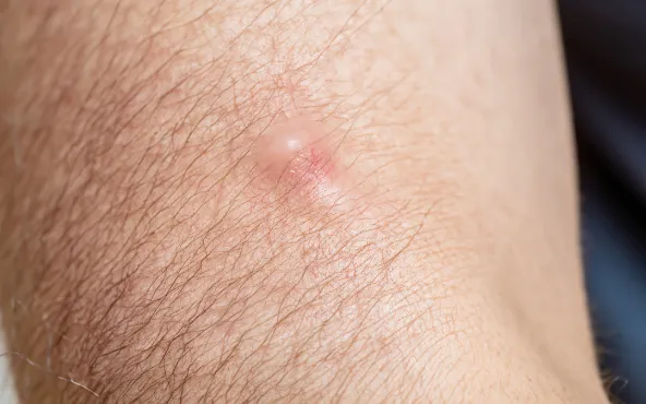 Keloid Nedir?